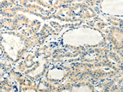 The image on the left is immunohistochemistry of paraffin-embedded Human thyroid cancer tissue using the antibody Antibody) at dilution 1/20, on the right is treated with synthetic peptide. (Original magnification: ×200)Rabbit anti-Human RXFP3 Polyclonal Antibody