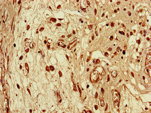 Immunohistochemistry of paraffin-embedded human lung cancer using SEC14L3 Antibody at dilution of 1:100Rabbit anti-Human SEC14L3 Polyclonal Antibody