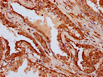 IHC image of the antibody diluted at 1:400 and staining in paraffin-embedded human prostate cancer performed on a Leica BondTM system. After dewaxing and hydration, antigen retrieval was mediated by high pressure in a citrate buffer (pH 6.0). Section was blocked with 10% normal goat serum 30min at RT. Then primary antibody (1% BSA) was incubated at 4°C overnight. The primary is detected by a biotinylated secondary antibody and visualized using an HRP conjugated SP system.Rabbit anti-Human IFT172 Polyclonal Antibody