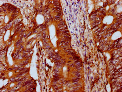 IHC image of IFT172 Antibody diluted at 1:400 and staining in paraffin-embedded human colon cancer performed on a Leica BondTM system. After dewaxing and hydration, antigen retrieval was mediated by high pressure in a citrate buffer (pH 6.0). Section was blocked with 10% normal goat serum 30min at RT. Then primary antibody (1% BSA) was incubated at 4°C overnight. The primary is detected by a biotinylated secondary antibody and visualized using an HRP conjugated SP system.Rabbit anti-Human IFT172 Polyclonal Antibody