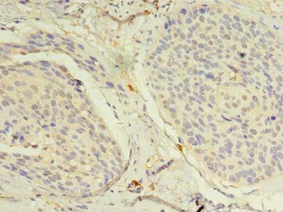 Immunohistochemistry of paraffin-embedded human cervical cancer using the antibody at dilution of 1:100Rabbit anti-Human NAT8 Polyclonal Antibody