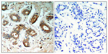 Immunohistochemical analysis of paraffin-embedded human breast carcinoma tissue using 14-3-3z(Phospho-Ser58) Antibody(left) or the same antibody preincubated with blocking peptide(right).Rabbit anti-Human YWHAZ Polyclonal Antibody