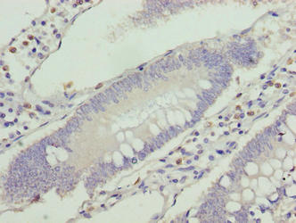 Immunohistochemistry of paraffin-embedded human colon cancer using VPS25 Antibody at dilution of 1:100Rabbit anti-Human VPS25 Polyclonal Antibody