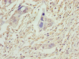 Immunohistochemistry of paraffin-embedded human pancreatic cancer using VPS25 Antibody at dilution of 1:100Rabbit anti-Human VPS25 Polyclonal Antibody