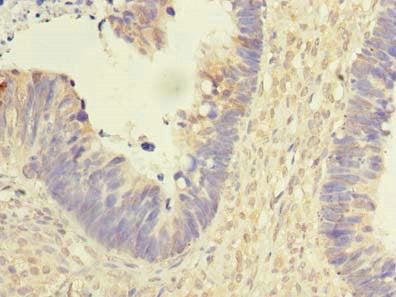 Immunohistochemistry of paraffin-embedded human ovarian cancer using the antibody at dilution of 1:100Rabbit anti-Human REEP2 Polyclonal Antibody
