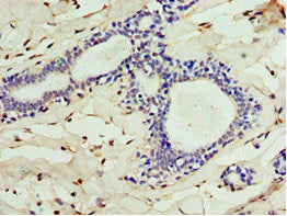 Immunohistochemistry of paraffin-embedded human breast cancer using ALG1 Antibody at dilution of 1:100Rabbit anti-Human ALG1 Polyclonal Antibody
