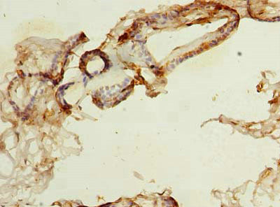 Immunohistochemistry of paraffin-embedded human breast cancer using NDFIP1 Antibody at dilution of 1:100Rabbit anti-Human NDFIP1 Polyclonal Antibody
