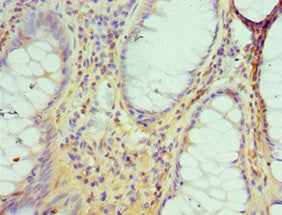 Immunohistochemistry of paraffin-embedded human colon cancer using DIDO1 Antibody at dilution of 1:100Rabbit anti-Human DIDO1 Polyclonal Antibody