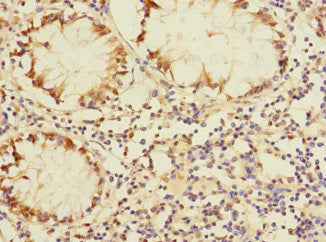 Immunohistochemistry of paraffin-embedded human colon cancer using DUSP16 Antibody at dilution of 1:100Rabbit anti-Human DUSP16 Polyclonal Antibody