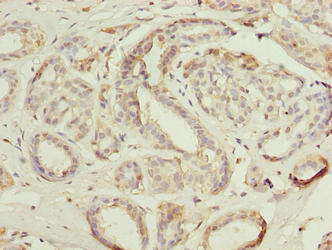 Immunohistochemistry of paraffin-embedded human breast cancer using ACTL8 Antibody at dilution of 1:100