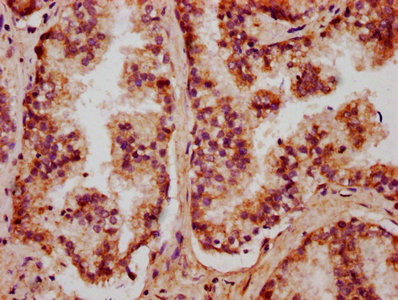 IHC image of CXorf36 Antibody diluted at 1:400 and staining in paraffin-embedded human prostate cancer performed on a Leica BondTM system. After dewaxing and hydration, antigen retrieval was mediated by high pressure in a citrate buffer (pH 6.0). Section was blocked with 10% normal goat serum 30min at RT. Then primary antibody (1% BSA) was incubated at 4°C overnight. The primary is detected by a biotinylated secondary antibody and visualized using an HRP conjugated SP system.Rabbit anti-Human CXorf36 Polyclonal Antibody