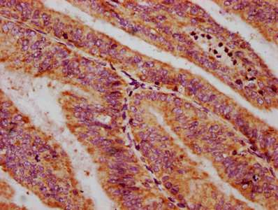IHC image of CXorf36 Antibody diluted at 1:400 and staining in paraffin-embedded human endometrial cancer performed on a Leica BondTM system. After dewaxing and hydration, antigen retrieval was mediated by high pressure in a citrate buffer (pH 6.0). Section was blocked with 10% normal goat serum 30min at RT. Then primary antibody (1% BSA) was incubated at 4°C overnight. The primary is detected by a biotinylated secondary antibody and visualized using an HRP conjugated SP system.Rabbit anti-Human CXorf36 Polyclonal Antibody