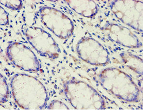 Immunohistochemistry of paraffin-embedded human colon cancer using ACAD9 Antibody at dilution of 1:100