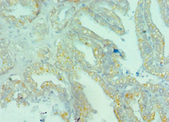 Immunohistochemistry of paraffin-embedded human bladder cancer using BRD9 Antibody at dilution of 1:100