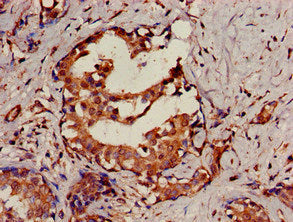 Immunohistochemistry of paraffin-embedded human breast cancer using SENP2 Antibody at dilution of 1:100