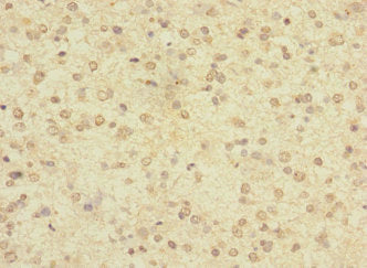 Immunohistochemistry of paraffin-embedded human glioma using LRRC4C Antibody at dilution of 1:100