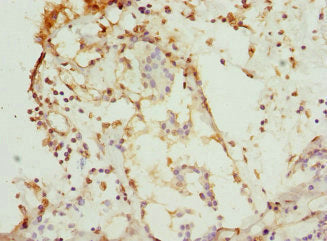 Immunohistochemistry of paraffin-embedded human breast cancer using CSNK1G1 Antibody at dilution of 1:100Rabbit anti-Human CSNK1G1 Polyclonal Antibody