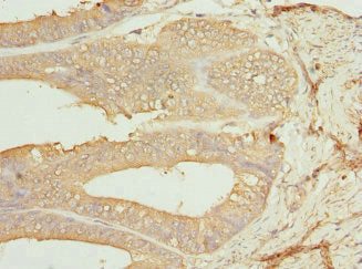 Immunohistochemistry of paraffin-embedded human endometrial cancer using CSNK1G1 Antibody at dilution of 1:100Rabbit anti-Human CSNK1G1 Polyclonal Antibody