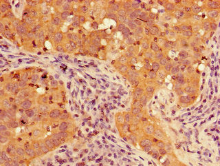 Immunohistochemistry of paraffin-embedded human pancreatic cancer using the antibody at dilution of 1:100Rabbit anti-Human TIGAR Polyclonal Antibody