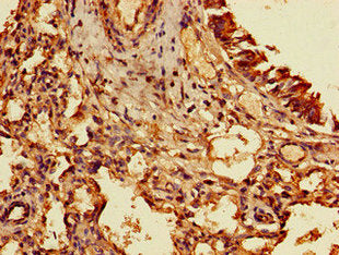 Immunohistochemistry of paraffin-embedded human lung cancer using TIGAR Antibody at dilution of 1:100Rabbit anti-Human TIGAR Polyclonal Antibody