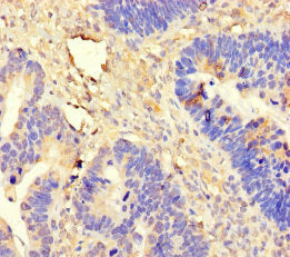 Immunohistochemistry of paraffin-embedded human ovarian cancer using DDX19A Antibody at dilution of 1:100Rabbit anti-Human DDX19A Polyclonal Antibody