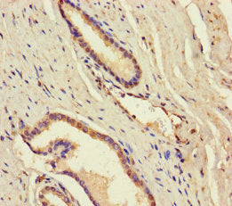 Immunohistochemistry of paraffin-embedded human prostate cancer using DDX19A Antibody at dilution of 1:100Rabbit anti-Human DDX19A Polyclonal Antibody