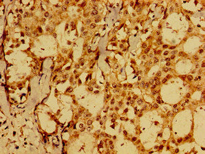 Immunohistochemistry of paraffin-embedded human breast cancer using FAIM Antibody at dilution of 1:100Rabbit anti-Human FAIM Polyclonal Antibody