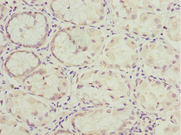 Immunohistochemistry of paraffin-embedded human gastric cancer using NLE1 Antibody at dilution of 1:100Rabbit anti-Human NLE1 Polyclonal Antibody
