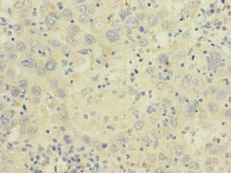 Immunohistochemistry of paraffin-embedded human liver cancer using CACNA2D2 Antibody at dilution of 1:100