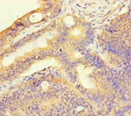Immunohistochemistry of paraffin-embedded human colon cancer using TAS2R13 Antibody at dilution of 1:100Rabbit anti-Human TAS2R13 Polyclonal Antibody