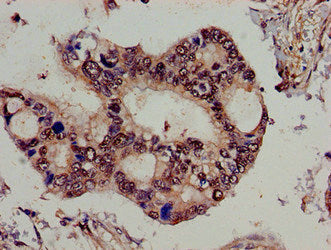 Immunohistochemistry of paraffin-embedded human pancreatic cancer using the antibody at dilution of 1:100Rabbit anti-Human SPG21 Polyclonal Antibody