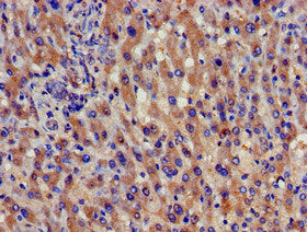 Immunohistochemistry of paraffin-embedded human liver cancer using SPG21 Antibody at dilution of 1:100Rabbit anti-Human SPG21 Polyclonal Antibody