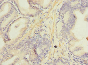 Immunohistochemistry of paraffin-embedded human prostate cancer using NDUFA13 Antibody at dilution of 1:100Rabbit anti-Human NDUFA13 Polyclonal Antibody