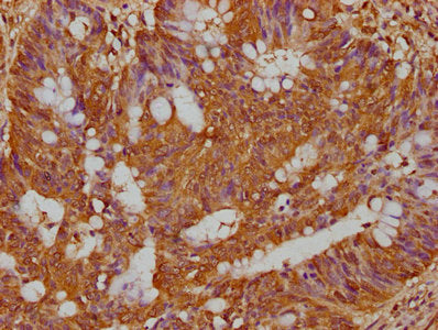 IHC image of the antibody diluted at 1:300 and staining in paraffin-embedded human colon cancer performed on a Leica BondTM system. After dewaxing and hydration, antigen retrieval was mediated by high pressure in a citrate buffer (pH 6.0). Section was blocked with 10% normal goat serum 30min at RT. Then primary antibody (1% BSA) was incubated at 4°C overnight. The primary is detected by a biotinylated secondary antibody and visualized using an HRP conjugated SP system.