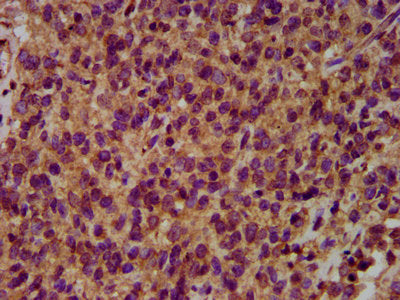 IHC image of HECW2 Antibody diluted at 1:500 and staining in paraffin-embedded human glioma performed on a Leica BondTM system. After dewaxing and hydration, antigen retrieval was mediated by high pressure in a citrate buffer (pH 6.0). Section was blocked with 10% normal goat serum 30min at RT. Then primary antibody (1% BSA) was incubated at 4°C overnight. The primary is detected by a biotinylated secondary antibody and visualized using an HRP conjugated SP system.Rabbit anti-Human HECW2 Polyclonal Antibody