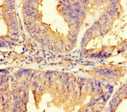 Immunohistochemistry of paraffin-embedded human endometrial cancer using IMPACT Antibody at dilution of 1:100Rabbit anti-Human IMPACT Polyclonal Antibody
