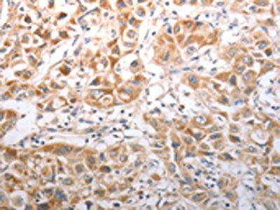 The image on the left is immunohistochemistry of paraffin-embedded Human lung cancer tissue using NQO1 Antibody(NQO1 Antibody) at dilution 1/40, on the right is treated with synthetic peptide. (Original magnification: ×200)Rabbit anti-Human NQO1 Polyclonal Antibody
