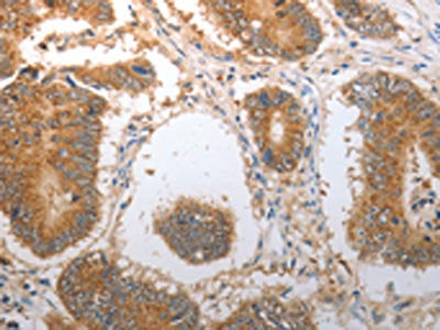 The image on the left is immunohistochemistry of paraffin-embedded Human colon cancer tissue using the antibody Antibody) at dilution 1/40, on the right is treated with synthetic peptide. (Original magnification: ×200)Rabbit anti-Human NQO1 Polyclonal Antibody