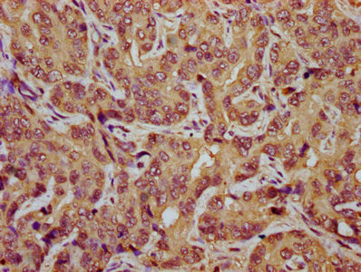 IHC image of TES Antibody diluted at 1:800 and staining in paraffin-embedded human liver cancer performed on a Leica BondTM system. After dewaxing and hydration, antigen retrieval was mediated by high pressure in a citrate buffer (pH 6.0). Section was blocked with 10% normal goat serum 30min at RT. Then primary antibody (1% BSA) was incubated at 4°C overnight. The primary is detected by a biotinylated secondary antibody and visualized using an HRP conjugated SP system.Rabbit anti-Human TES Polyclonal Antibody