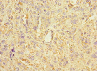 Immunohistochemistry of paraffin-embedded human melanoma using ASIC3 Antibody at dilution of 1:100Rabbit anti-Human ASIC3 Polyclonal Antibody