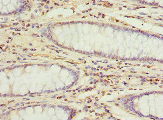 Immunohistochemistry of paraffin-embedded human colon cancer using DDX20 Antibody at dilution of 1:100Rabbit anti-Human DDX20 Polyclonal Antibody