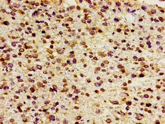 Immunohistochemistry of paraffin-embedded human glioma using FOXD3 Antibody at dilution of 1:100Rabbit anti-Human FOXD3 Polyclonal Antibody