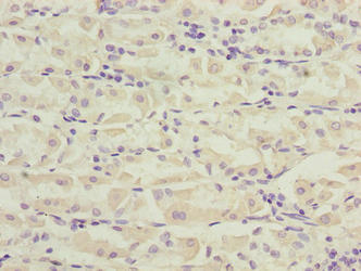 Immunohistochemistry of paraffin-embedded human gastric cancer using PILRB Antibody at dilution of 1:100Rabbit anti-Human PILRB Polyclonal Antibody