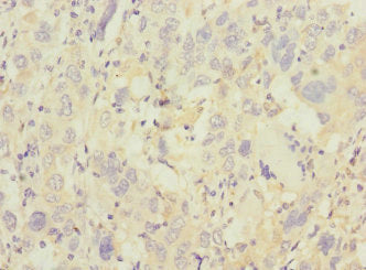 Immunohistochemistry of paraffin-embedded human liver cancer using TRHDE Antibody at dilution of 1:100