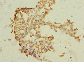 Immunohistochemistry of paraffin-embedded human breast cancer using TRHDE Antibody at dilution of 1:100