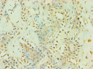Immunohistochemistry of paraffin-embedded human breast cancer using BAG5 Antibody at dilution of 1:100