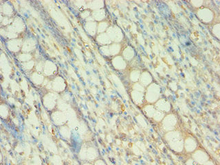 Immunohistochemistry of paraffin-embedded human colon tissue using BAG5 Antibody at dilution of 1:100