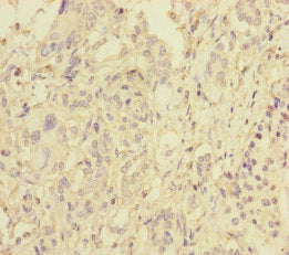 Immunohistochemistry of paraffin-embedded human pancreatic cancer using BLOC1S6 Antibody at dilution of 1:100
