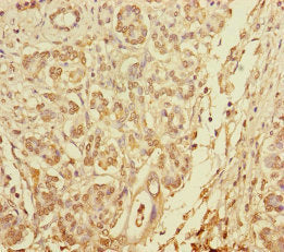 Immunohistochemistry of paraffin-embedded human pancreatic cancer using BLOC1S6 Antibody at dilution of 1:100
