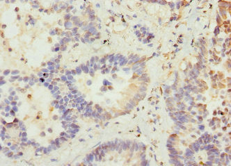 Immunohistochemistry of paraffin-embedded human lung cancer using VANGL2 Antibody at dilution of 1:100Rabbit anti-Human VANGL2 Polyclonal Antibody